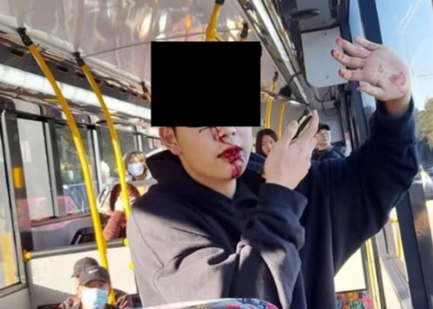 華留學生坐巴士遭辱罵鐵棍打甩多隻牙｜即時新聞｜兩岸｜on.cc東網