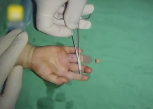 2歲男童遭門縫夾甩肉醫生駁回0 2毫米血管 即時新聞 兩岸 On Cc東網