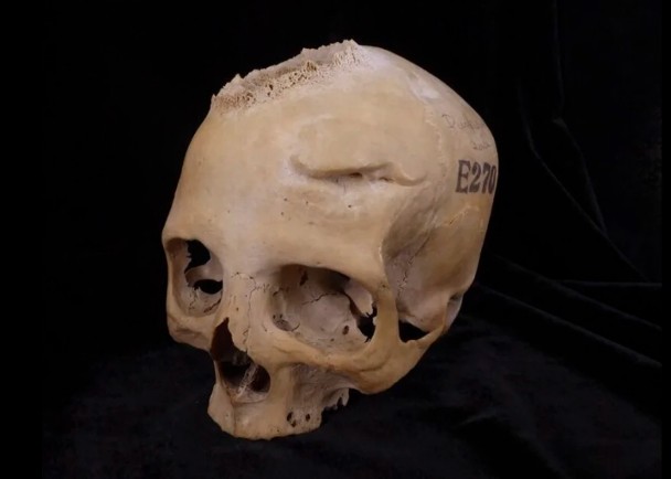 古埃及癌患頭骨發現腫瘤切痕　或為手術痕迹
