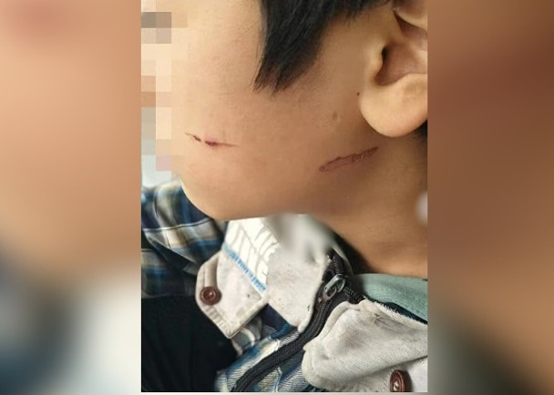 14歲男生遭同學霸凌　掌摑及燒紅釘子灼傷臉